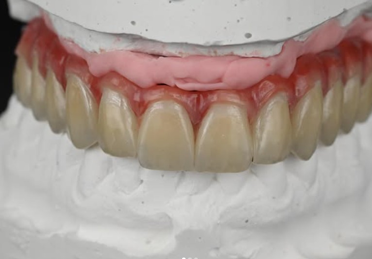 Disilicate Work 1