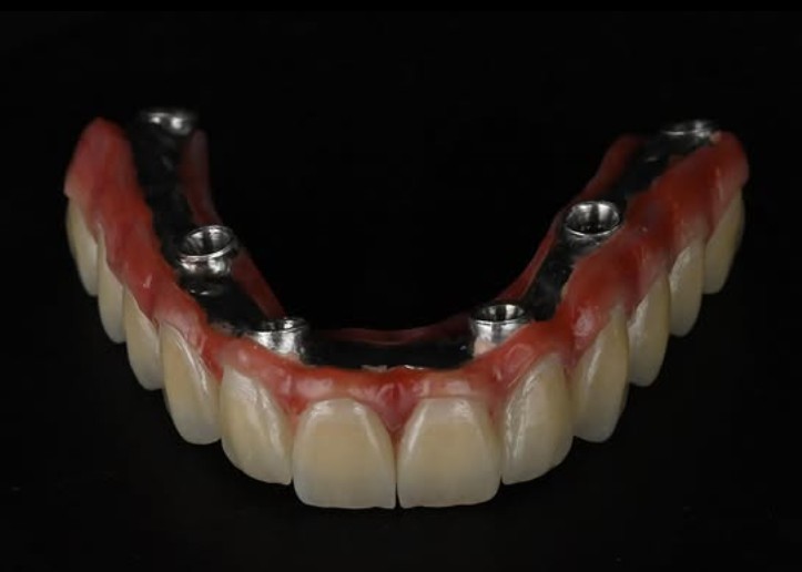 Implant Work 1